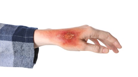 Woman with burn on her hand against white background, closeup