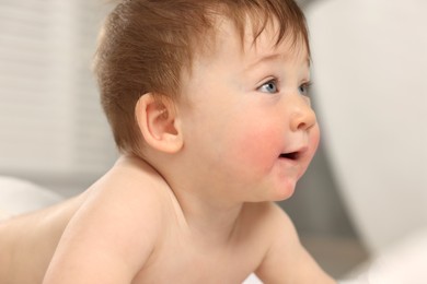 Photo of Cute little baby with allergic redness on cheeks indoors, closeup