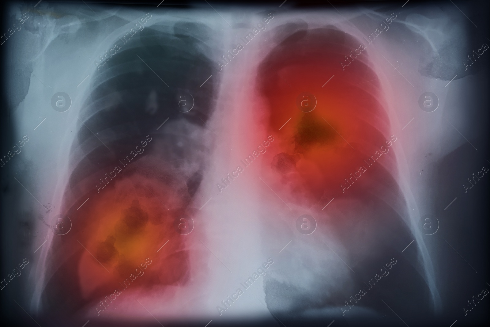 Illustration of X-ray image of patient with lung cancer. Illustration