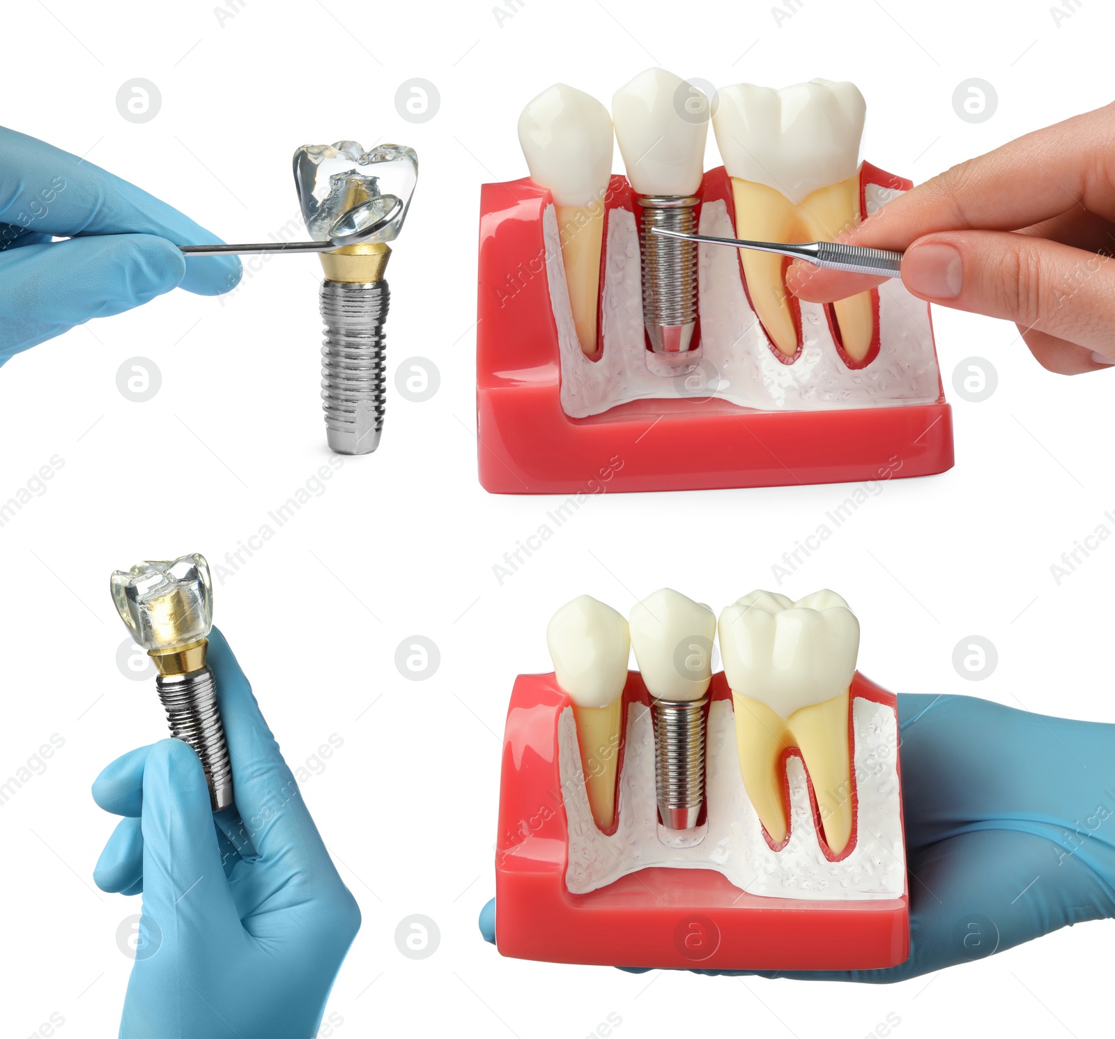 Image of Dentists showing educational models of dental implants on white background, closeup. Collage 