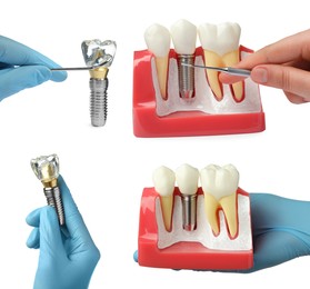 Dentists showing educational models of dental implants on white background, closeup. Collage 