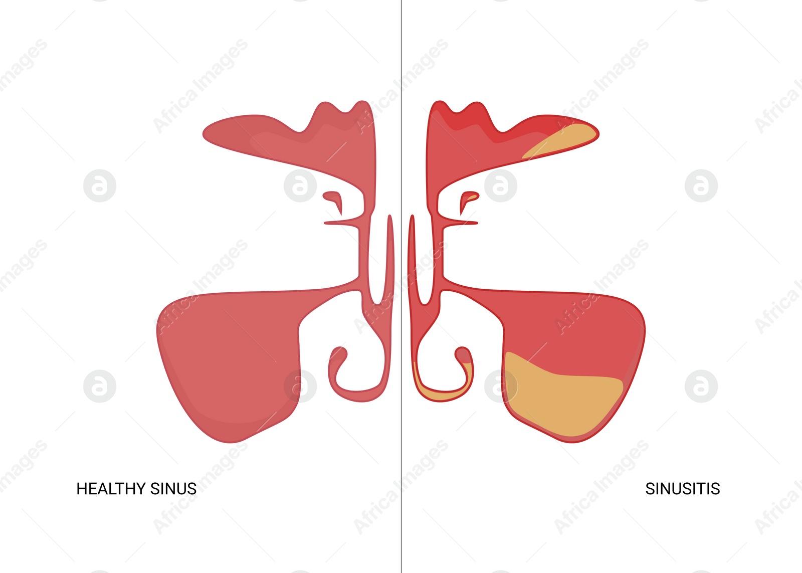 Illustration of  healthy and inflamed paranasal sinuses on white background