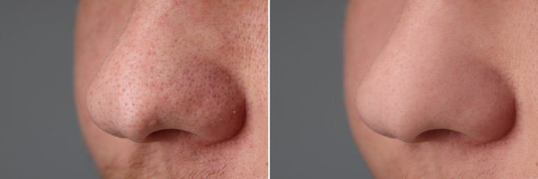 Image of Before and after acne treatment. Photos of man on grey background, closeup. Collage showing affected and healthy skin