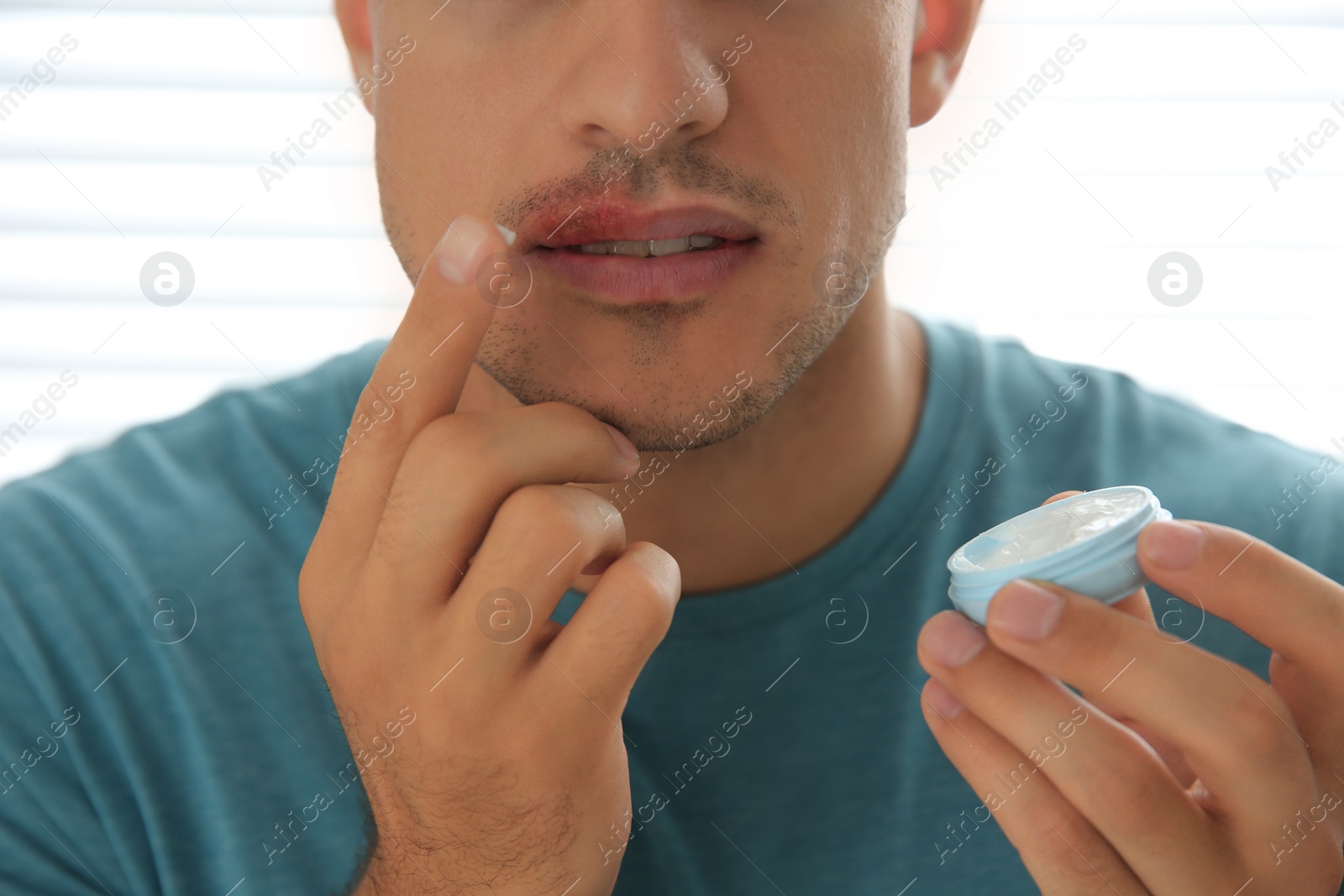 Photo of Man with herpes applying cream on lips against light background, closeup