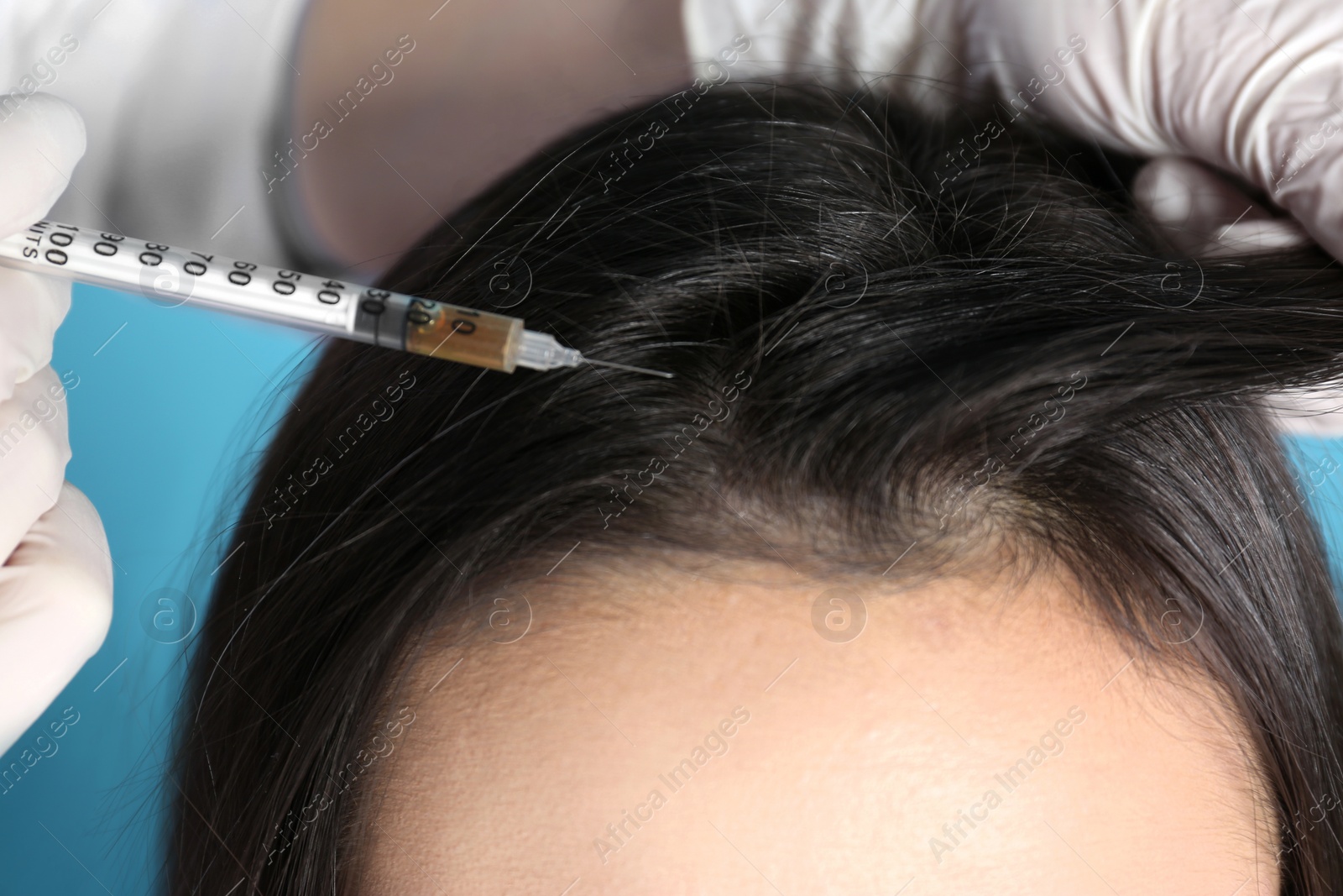Photo of Young woman with hair loss problem receiving injection on color background, closeup