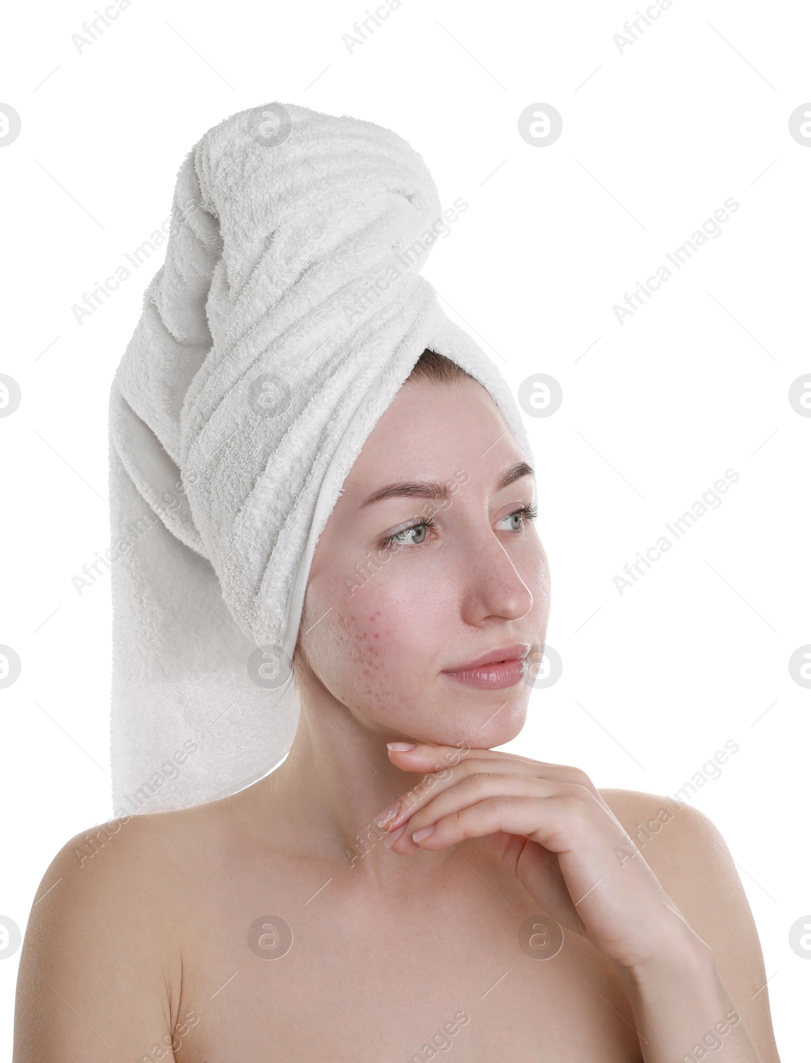 Photo of Young woman with acne problem on white background