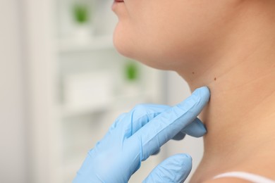 Dermatologist examining patient's birthmark indoors, closeup view