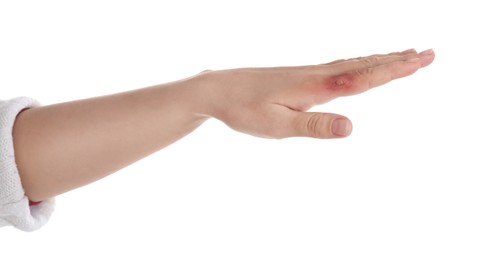 Photo of Woman with burn of her hand on white background, closeup