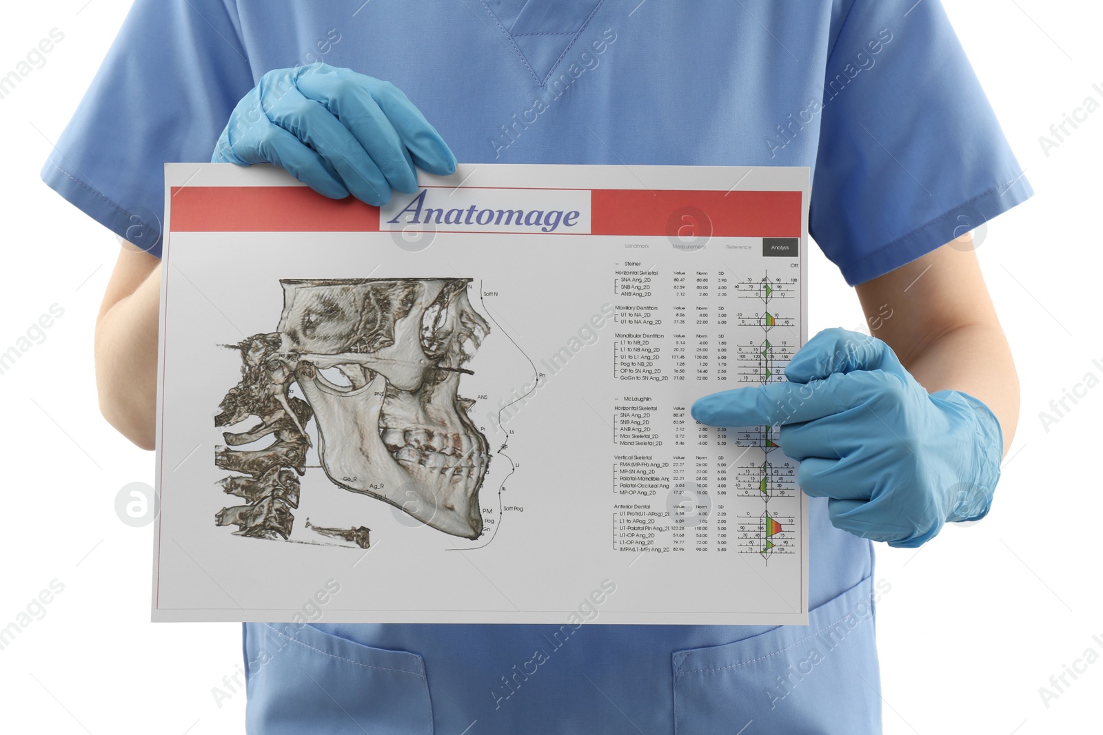 Photo of Doctor with visualization of human maxillofacial section for dental analysis printed on paper isolated on white, closeup. Cast of teeth