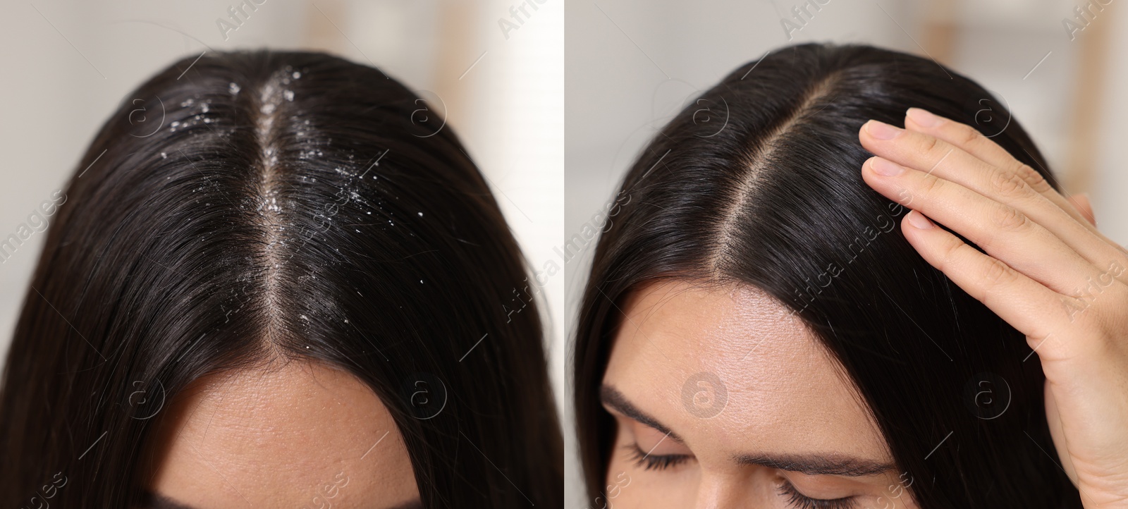 Image of Woman showing hair before and after dandruff treatment, collage