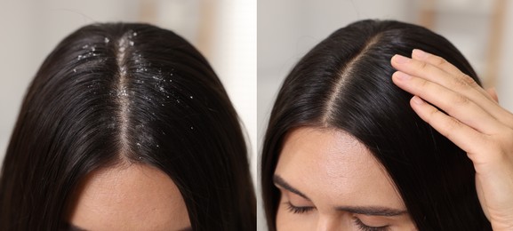 Woman showing hair before and after dandruff treatment, collage