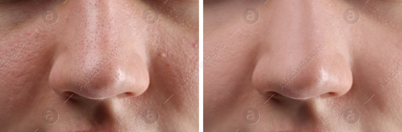 Image of Photos of woman before and after acne treatment, closeup. Collage showing affected and healthy skin