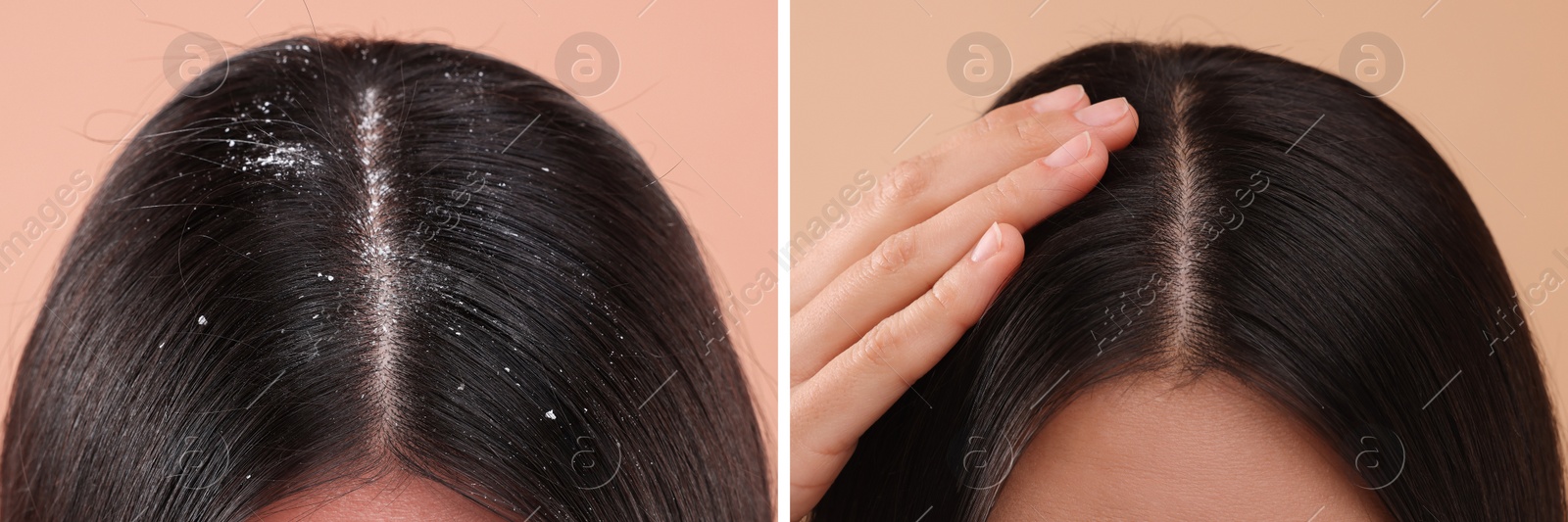 Image of Woman showing hair before and after dandruff treatment on beige background, collage