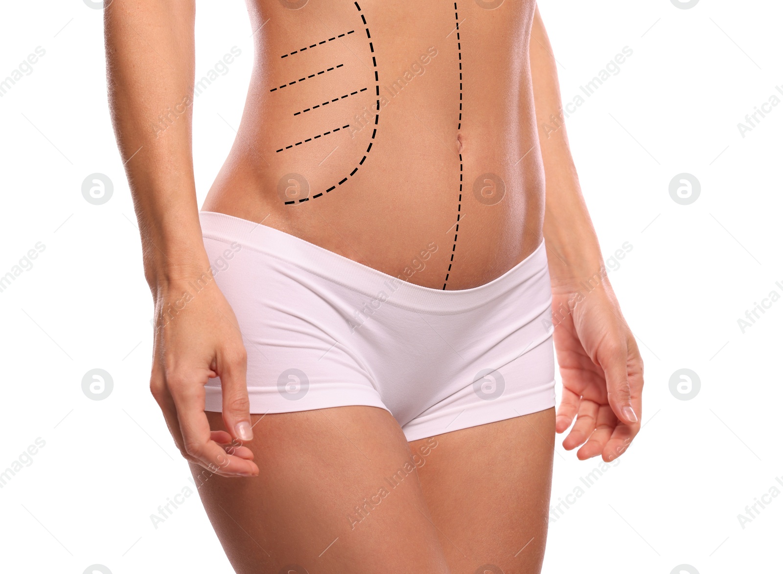 Image of Woman with markings for cosmetic surgery on her abdomen against white background, closeup