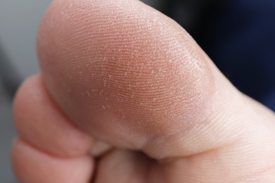 Photo of Woman with dry skin on toes against blurred background, closeup