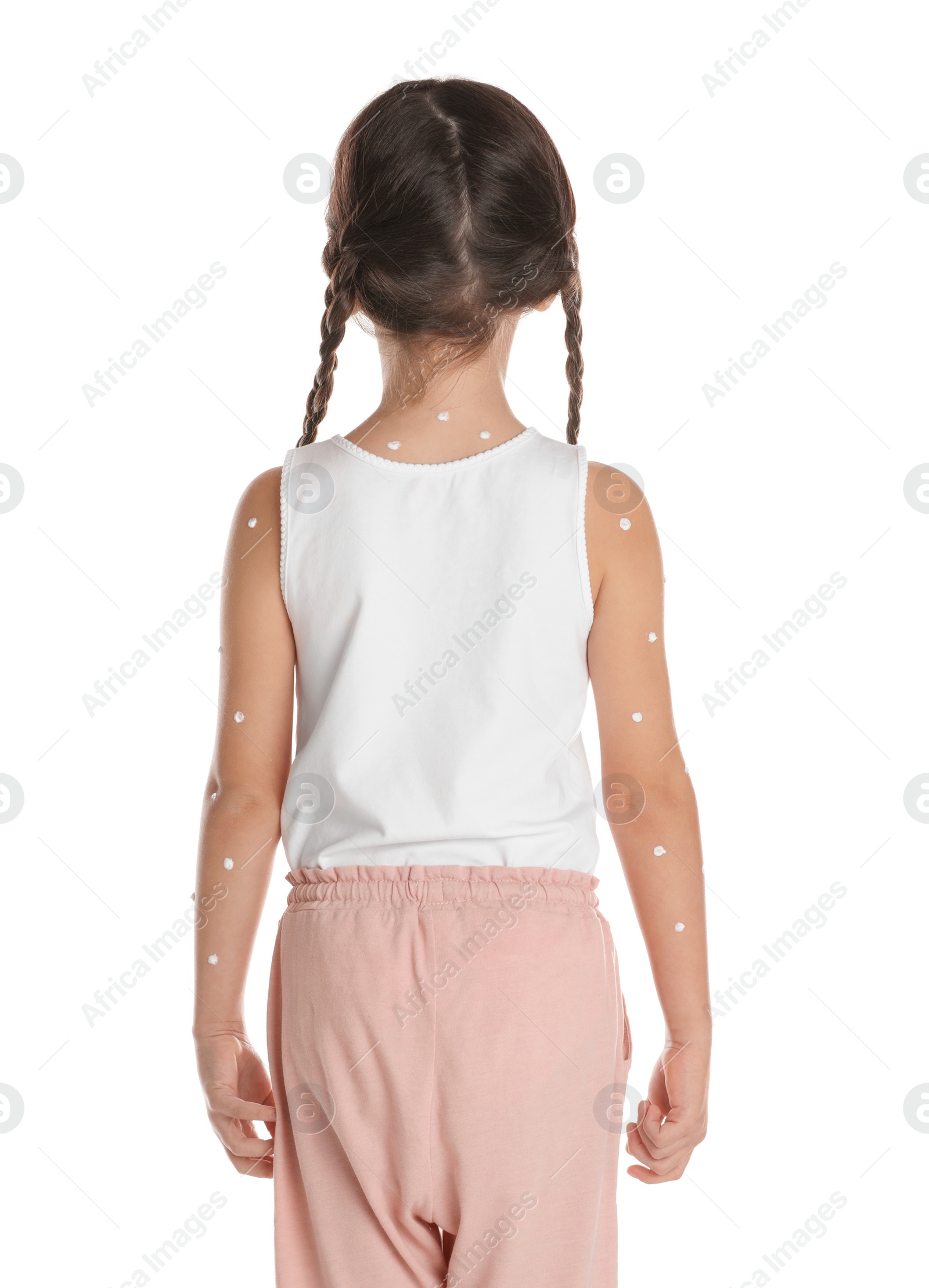 Photo of Little girl with chickenpox on white background, back view