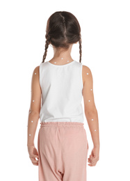 Little girl with chickenpox on white background, back view