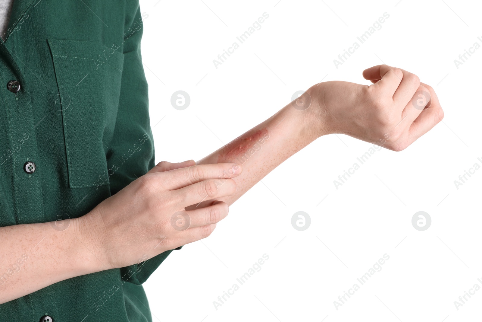 Photo of Woman with burned hand on white background, closeup