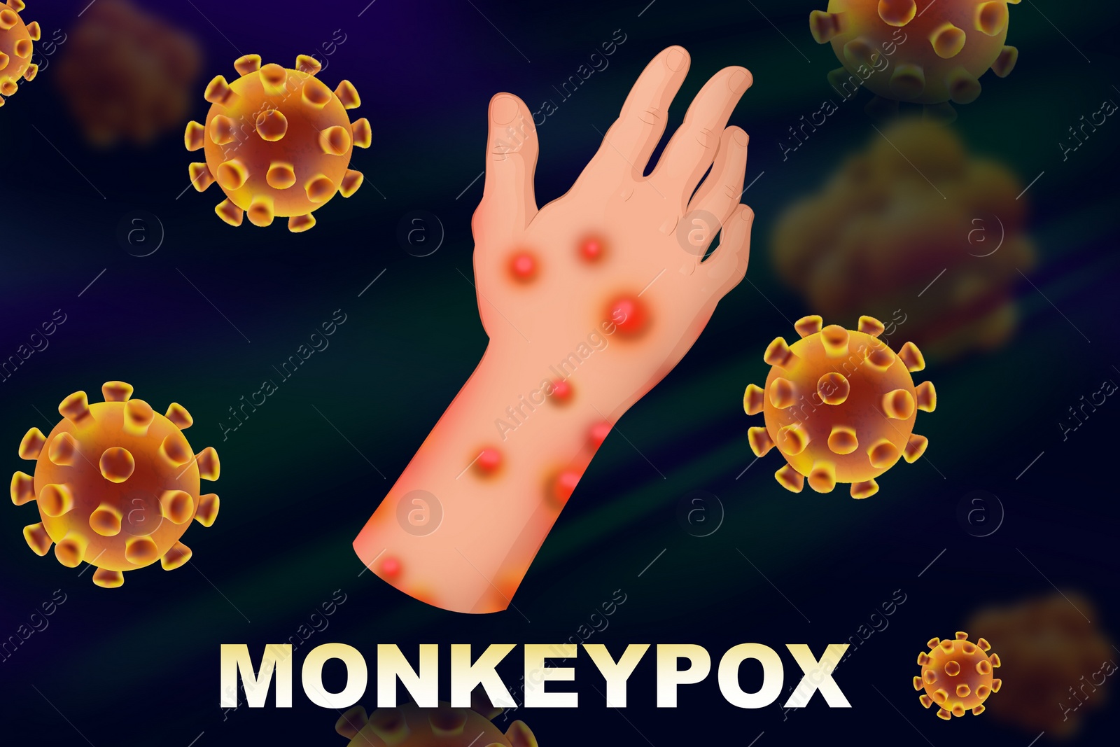 Illustration of Person diseased by monkeypox virus, illustration. Dangerous disease