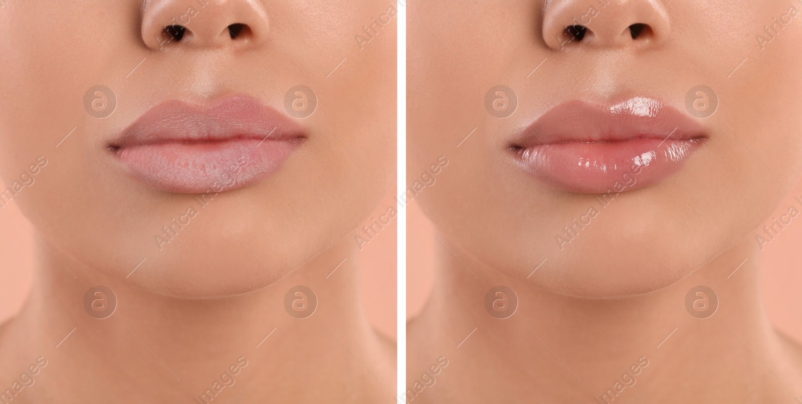 Image of Collage with photos of woman with dry and moisturized lips, closeup. Banner design