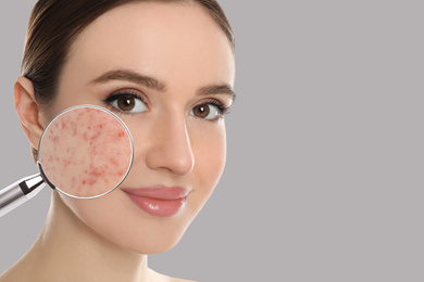 Image of Young woman with acne problem on grey background, space for text. Skin under magnifying glass