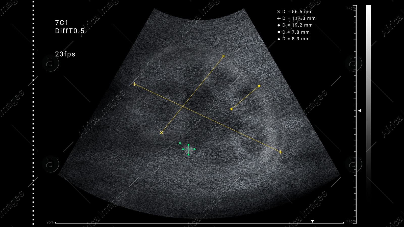 Illustration of Sonogram of human kidney, illustration. Ultrasound diagnostic