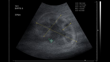 Illustration of Sonogram of human kidney, illustration. Ultrasound diagnostic