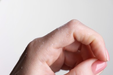 Photo of Woman with dry skin on hand against light background, macro view