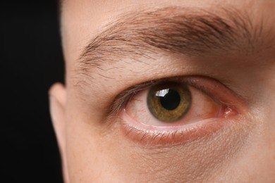 Man with red eye suffering from conjunctivitis on dark background, closeup