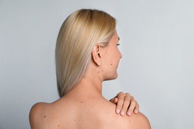 Photo of Young woman with birthmarks on light grey background, back view