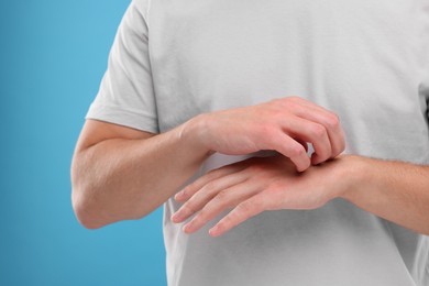 Photo of Allergy symptom. Man scratching his hand on light blue background, closeup