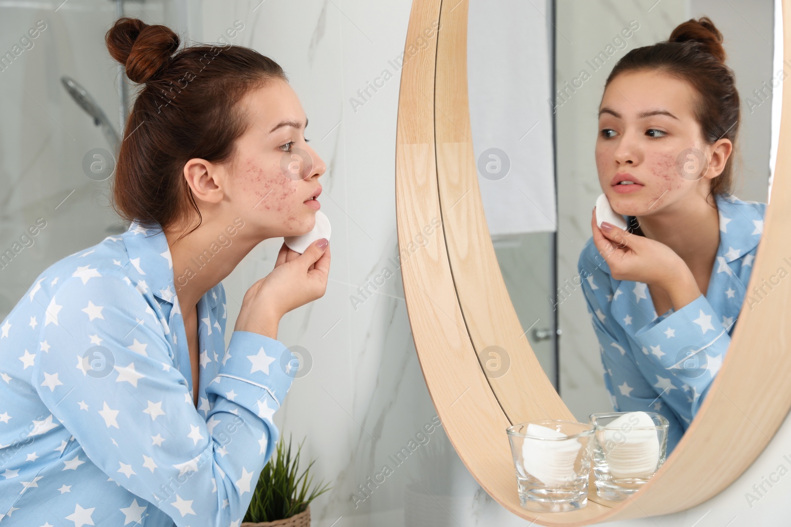 Photo of Teen girl with acne problem cleaning her face near mirror in bathroom