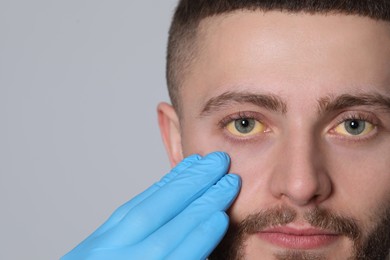 Doctor checking yellow eyes of patient on light grey background, closeup and space for text. Hepatitis symptom