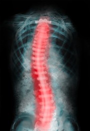 Illustration of X-ray of human spine showing curvature. Patient suffering from scoliosis