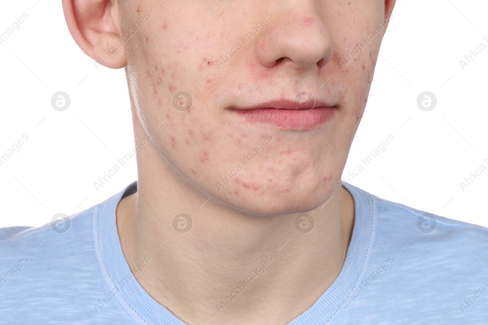 Photo of Young man with acne problem isolated on white, closeup