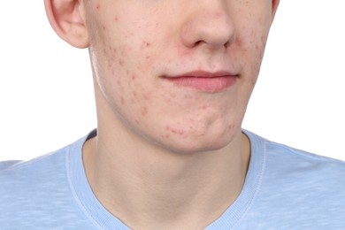 Young man with acne problem isolated on white, closeup