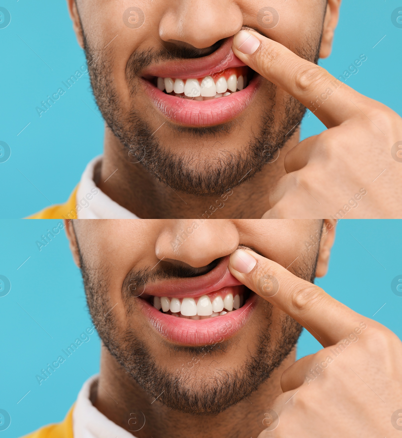 Image of Man showing gum before and after treatment on light blue background, collage of photos