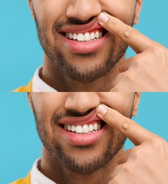 Man showing gum before and after treatment on light blue background, collage of photos