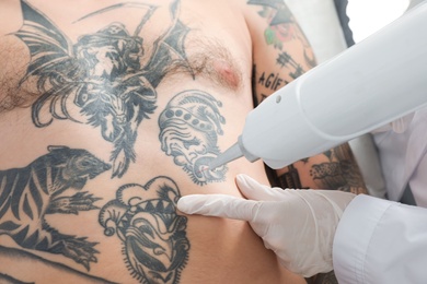 Photo of Man undergoing laser tattoo removal procedure in salon, closeup