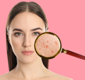 Young woman with acne problem on pink background. Skin under magnifying glass