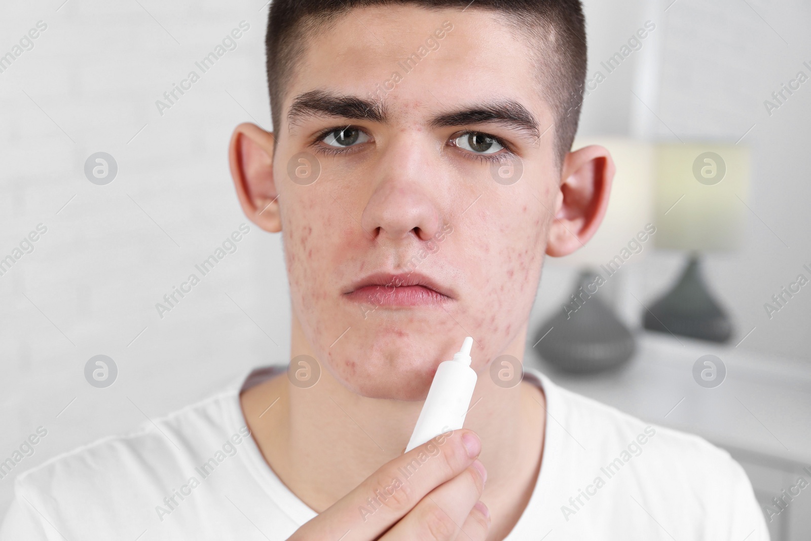 Photo of Young man with acne problem applying cosmetic product onto his skin indoors