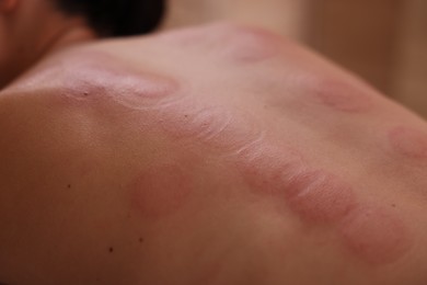 Photo of Closeup view of woman after cupping therapy indoors