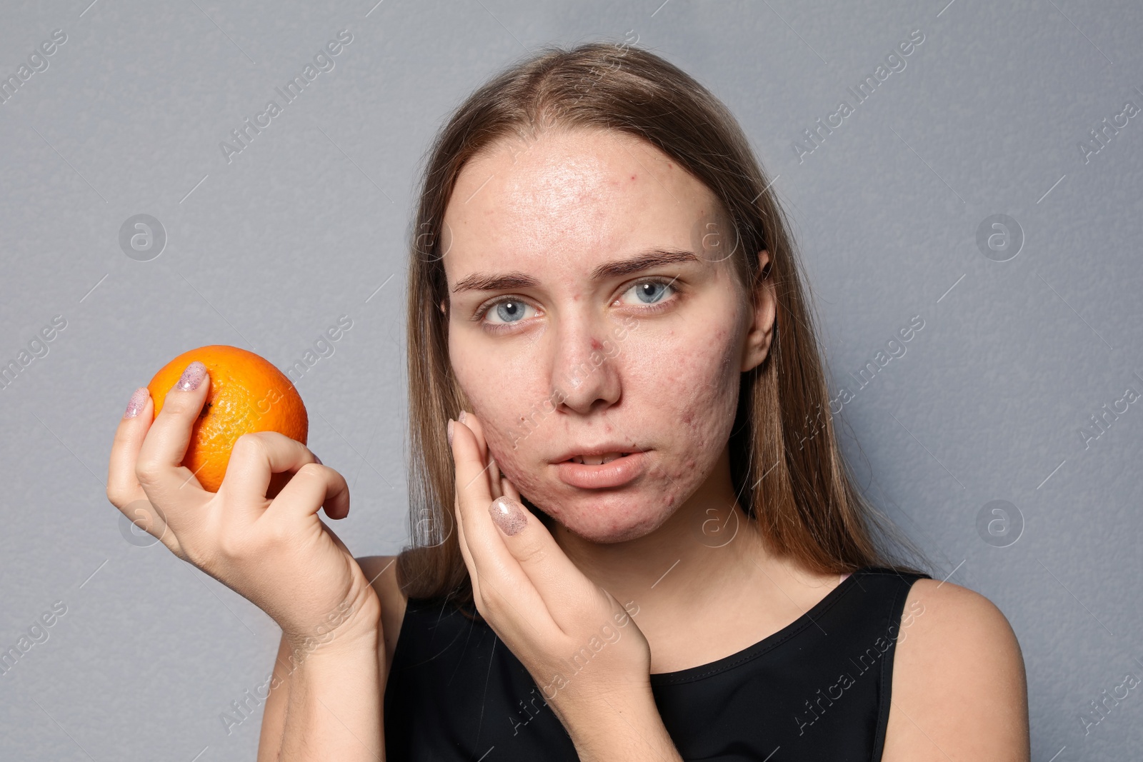 Photo of Young woman with acne problem holding orange on color background. Skin allergy