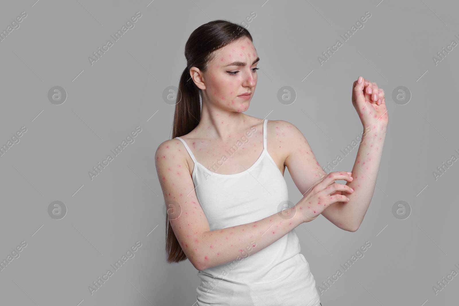 Photo of Woman with rash suffering from monkeypox virus on light grey background