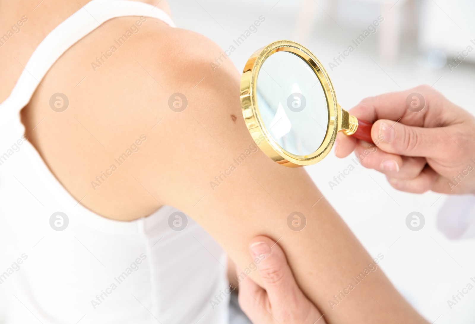 Photo of Dermatologist examining patient's birthmark with magnifying glass in clinic, closeup