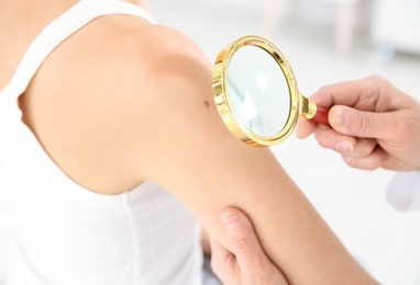 Dermatologist examining patient's birthmark with magnifying glass in clinic, closeup