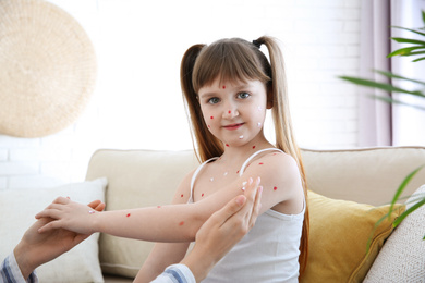 Photo of Woman applying cream onto skin of little girl with chickenpox at home