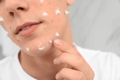 Teen guy with acne problem applying cream indoors, closeup