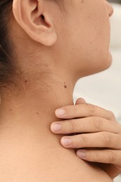 Photo of Closeup view of woman`s body with birthmarks