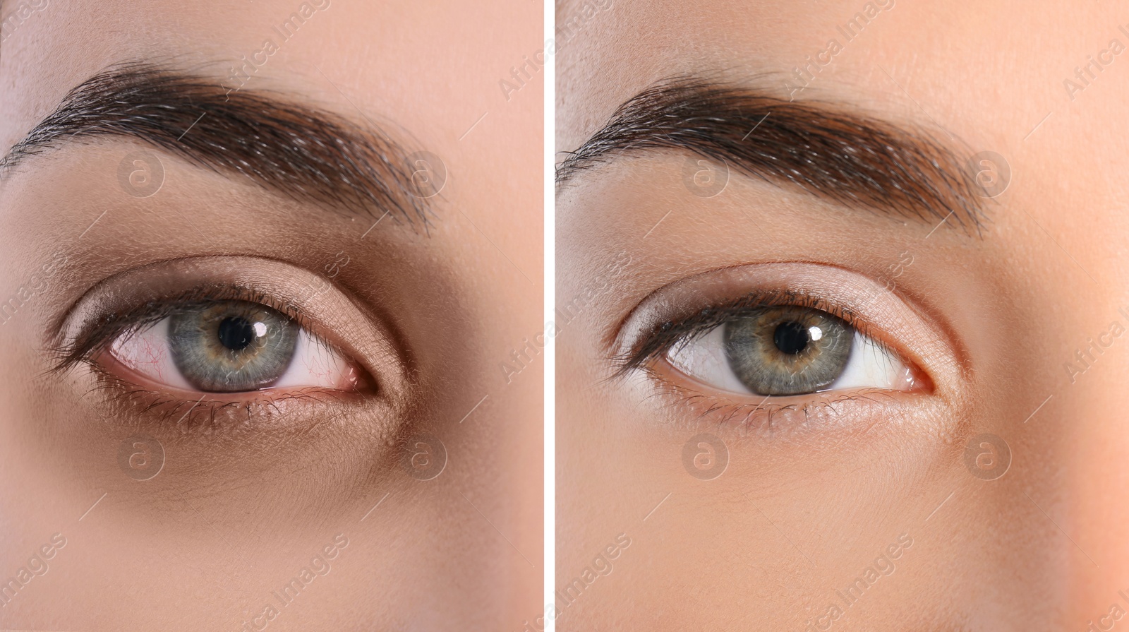 Image of Collage with photos of tired woman with dark circle under eye and after rest, closeup